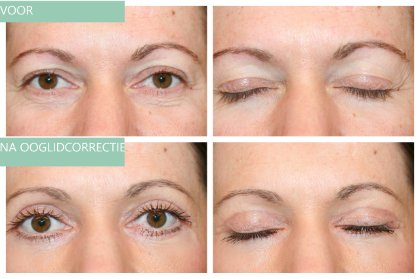 Woman eyelid surgery before and after