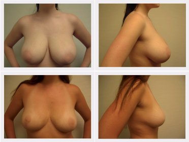 Breast reduction before and after photos Plastic Surgeon Dr Nelissen #globalcareclinic