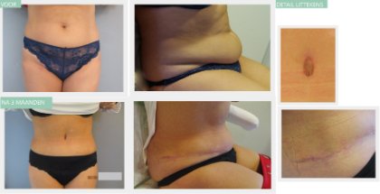 Tummy Tuck after 3 months with detailed scars