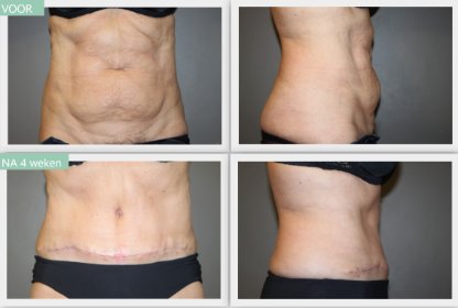 Tummy Tuck after 4 weeks