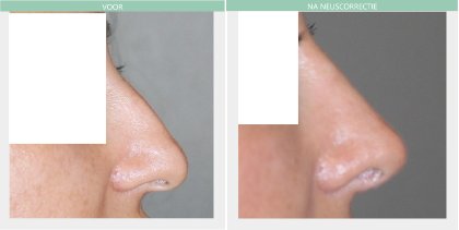 Nose job before and after Dr Nelissen 