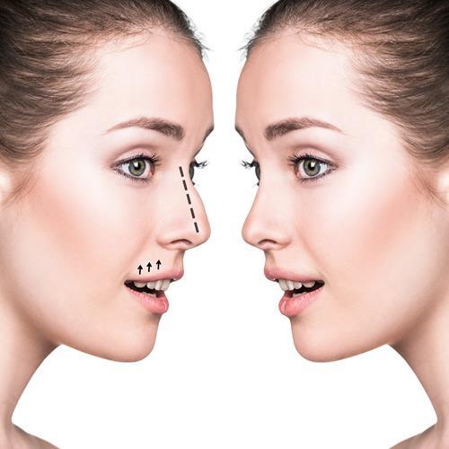 Are you not so happy with your nose? Is rhinoplasty a long-cherished wish?