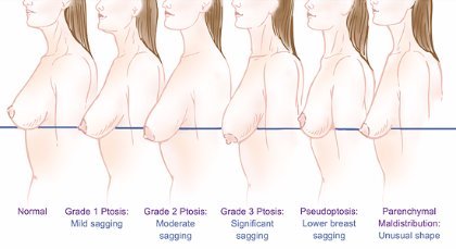 Global Care Clinic breast uplift