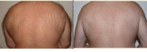 Global Care Clinic laser hair removal before and after