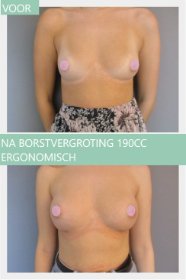 breast augmentation before and after with 190cc