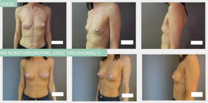 breast augmentation before and after with 205cc