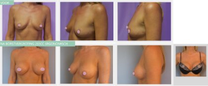 breast augmentation before and after with 265cc