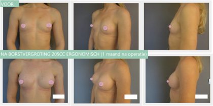 breast augmentation before and after 205cc (after 1 month)