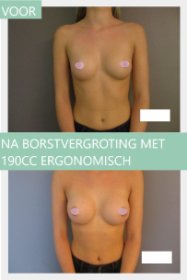 breast augmentation before and after with 190cc