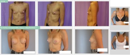 breast augmentation before and after with 205cc