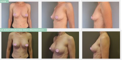 breast augmentation before and after 205cc
