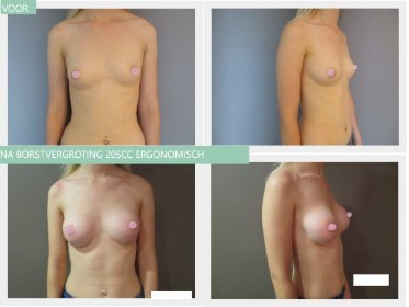 breast augmentation before and after with 205cc