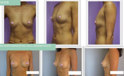 breast augmentation before and after with 245cc