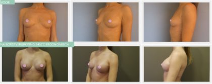 breast augmentation before and after with 245cc