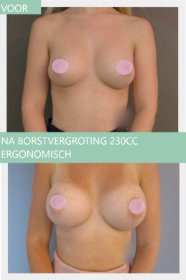 breast augmentation before and after with 230cc