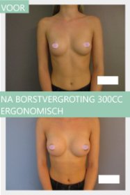 breast augmentation before and after with 300cc