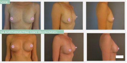 breast augmentation before and after 220cc