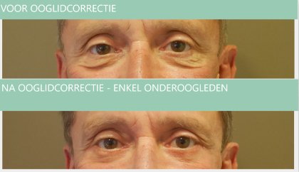 Eyelid surgery man under eyelid