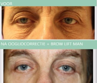 Man ooglidcorrectie + brow lift