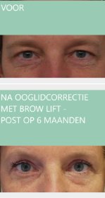 Eyelid surgery + brow lift - post op 6 months