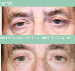 Man ooglidcorrectie + Directe Browlift