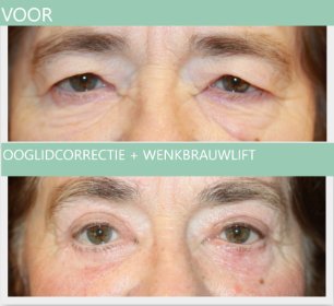 Eyelid surgery + brow lift 