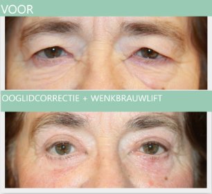 Ooglidcorrectie + directe brow lift vrouw