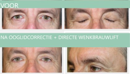 Male eyelid surgery + brow lift 