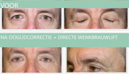 Man ooglidcorrectie + brow lift 