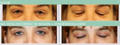 Eyelid surgery upper + lower eyelids