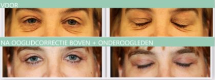 Ooglidcorrectie boven + onderoogleden