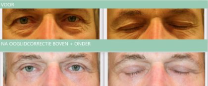 Eyelid surgery man upper+lower