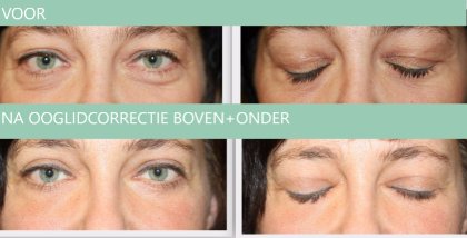 Ooglidcorrectie boven+onder