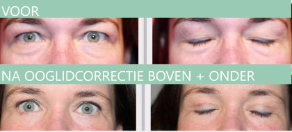 Ooglidcorrectie boven + onder