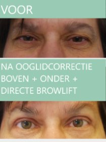 Ooglidcorrectie boven + onder + directe browlift