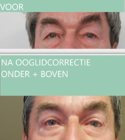 Man ooglidcorrectie boven en onder