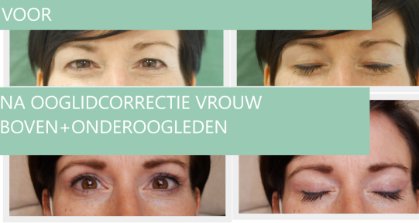 Vrouw ooglidcorrectie boven milanese + onder