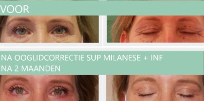 Ooglidcorrectie vrouw sup milanese + inf - resultaat na 2 maanden