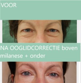 Ooglidcorrectie vrouw boven milanese + onderoogleden