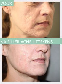 Filler acne scars