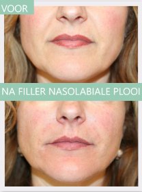 Filler nasolabiale plooi