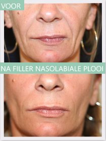 Filler nasolabiale plooi