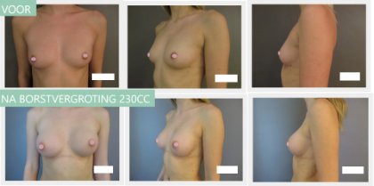 Round breast implants 230cc