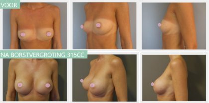 Round breast implants 315cc