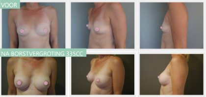 Round breast implants 335cc