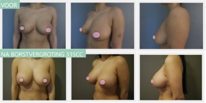 Round breast implants 335cc