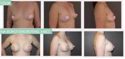 Round breast implants 340cc