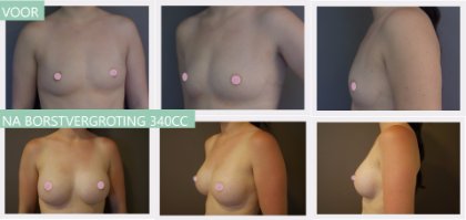 Round breast implants 340cc