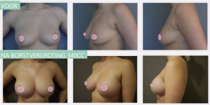 Round breast implants 340cc