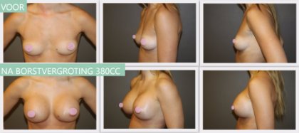 Round breast implants 380cc
